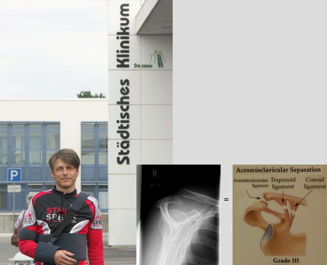 Ultra Skate Challenge Germany 2013. Acromioclavicular separation, Schultereckgelenksprengung, Acromioklavikularledsluxation. (X-ray by Städtisches Klinikum, Dessau, Germany.)