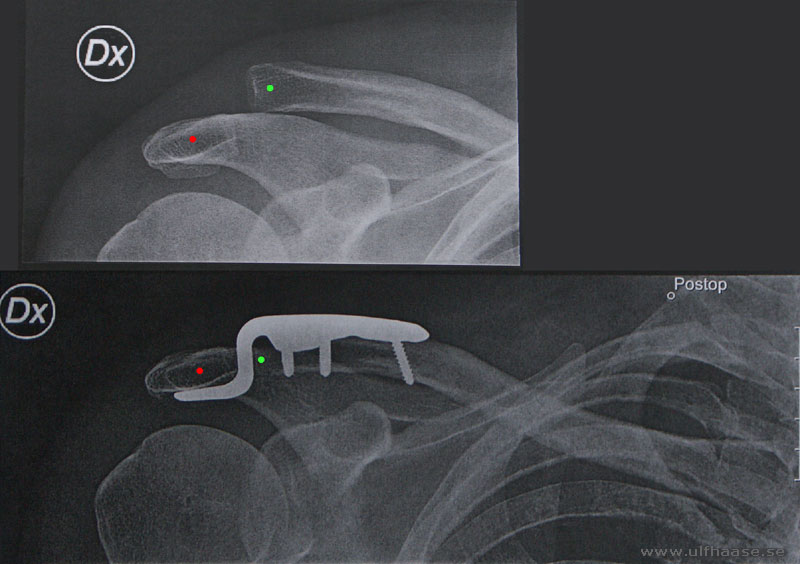 Acromioclavicular separation, Schultereckgelenksprengung, Acromioklavikularledsluxation, hook. X-ray by S:t Görans Hospital, Stockholm, Sweden.